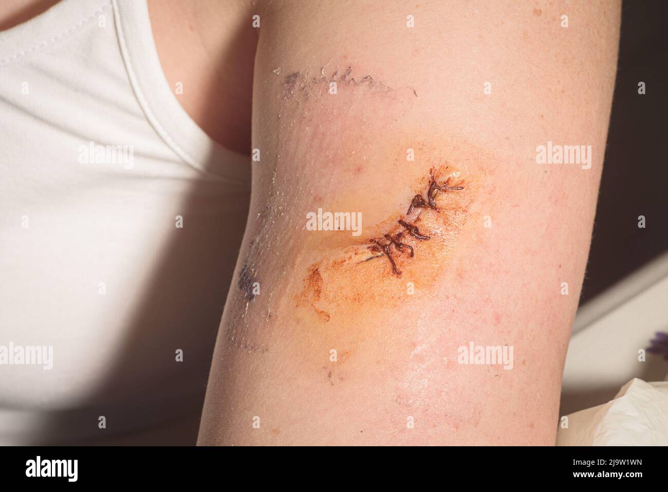 Post-operative wound after removing a mole, closed with surgical stitches, on the arm of a woman, disinfected after removing the plast. Stock Photo