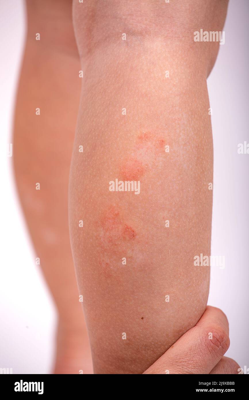 atopic dermatitis on children's feet Stock Photo Alamy