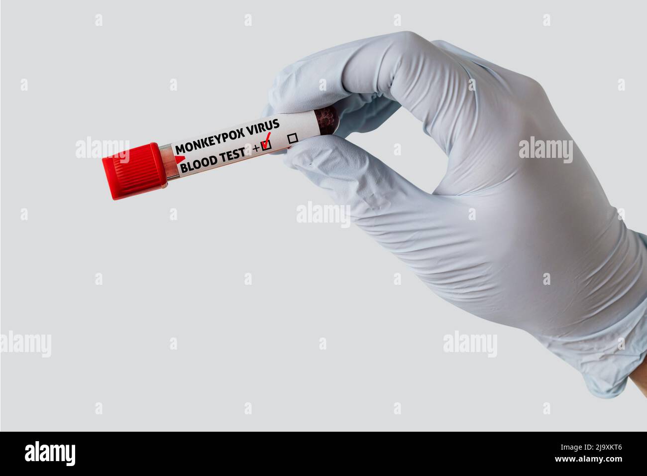 Hand of doctor holding blood tests from monkeypox virus patient Stock ...