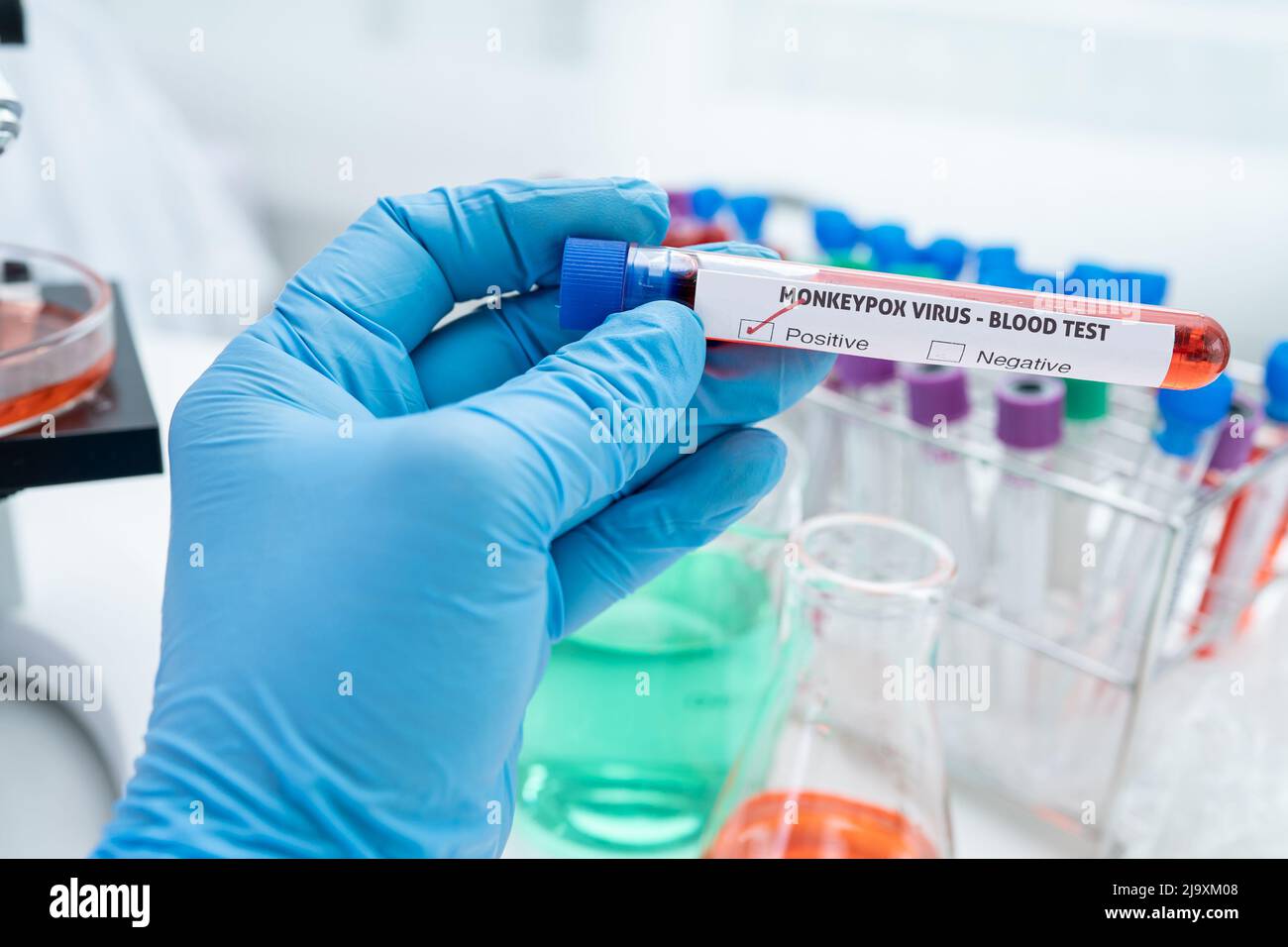 monkeypox virus Positive blood test tube Stock Photo - Alamy