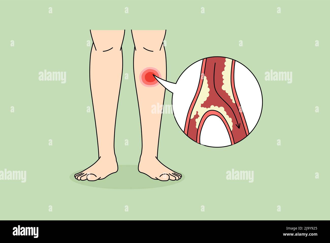 Close up of person suffer from PAD disease having blood vessel blockage in legs. Man struggle with clotted limbs from veins narrowing or blocking. Healthcare concept. Vector illustration.  Stock Vector