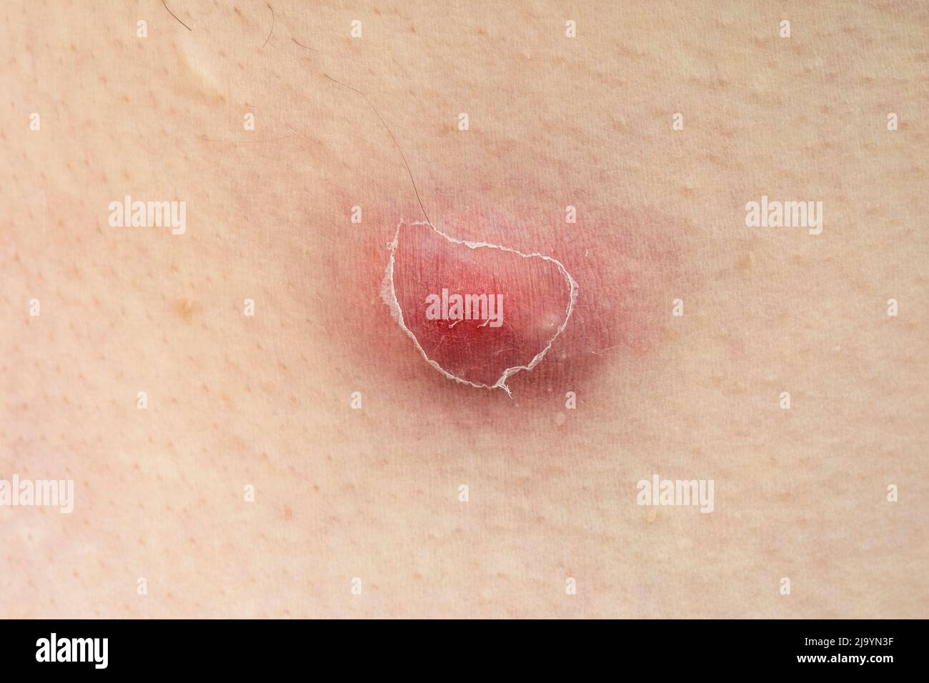 Close-up of furuncle, acne, pimple with pus under skin Stock Photo - Alamy