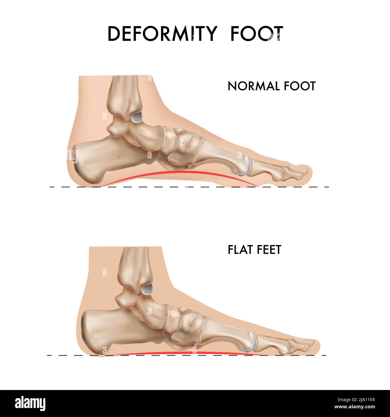 Realistic bones anatomy foot arch deformation composition with profile views of footstep with editable text captions vector illustration Stock Vector