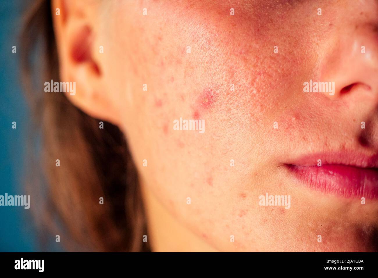 post-acne, scars and red festering pimples on the face of a young woman. concept of skin problems and harmonic failure Stock Photo