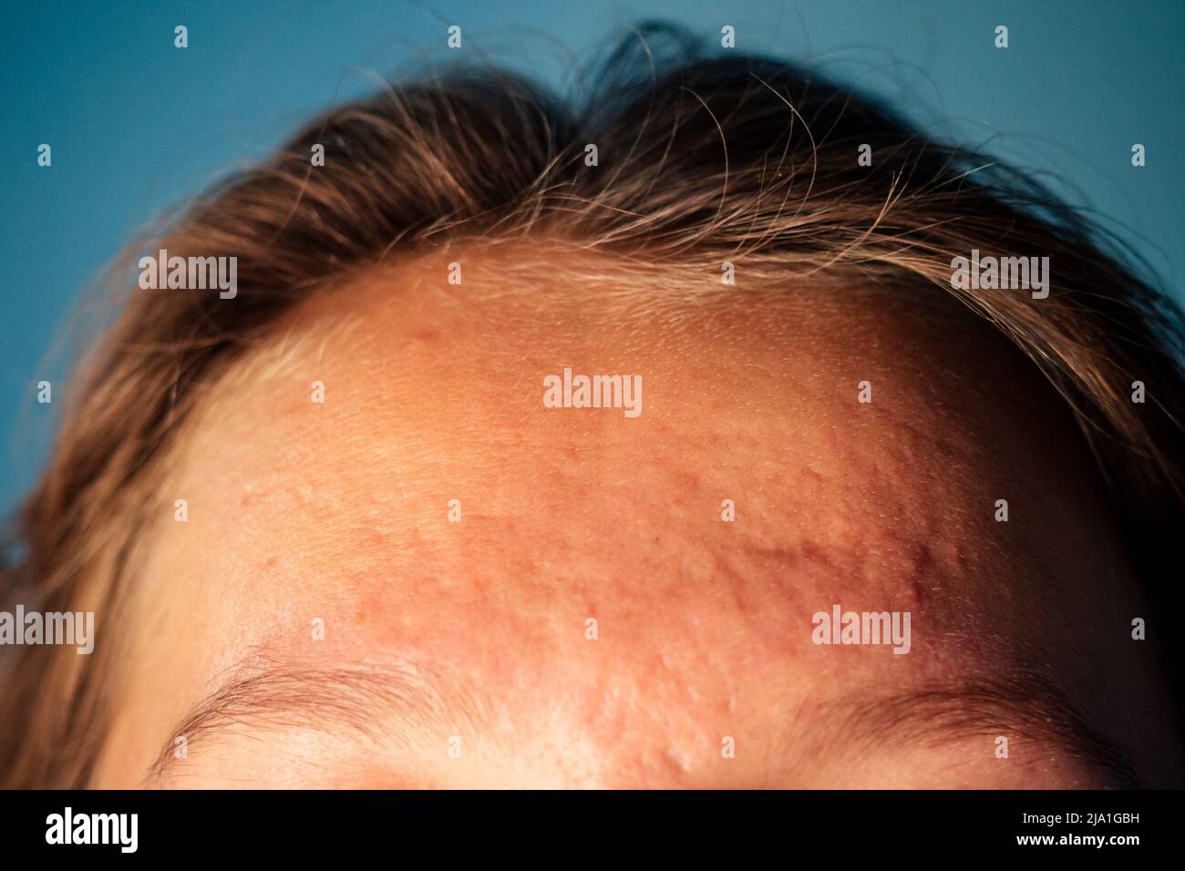 post-acne, scars and red festering pimples on the face of a young woman. Stock Photo