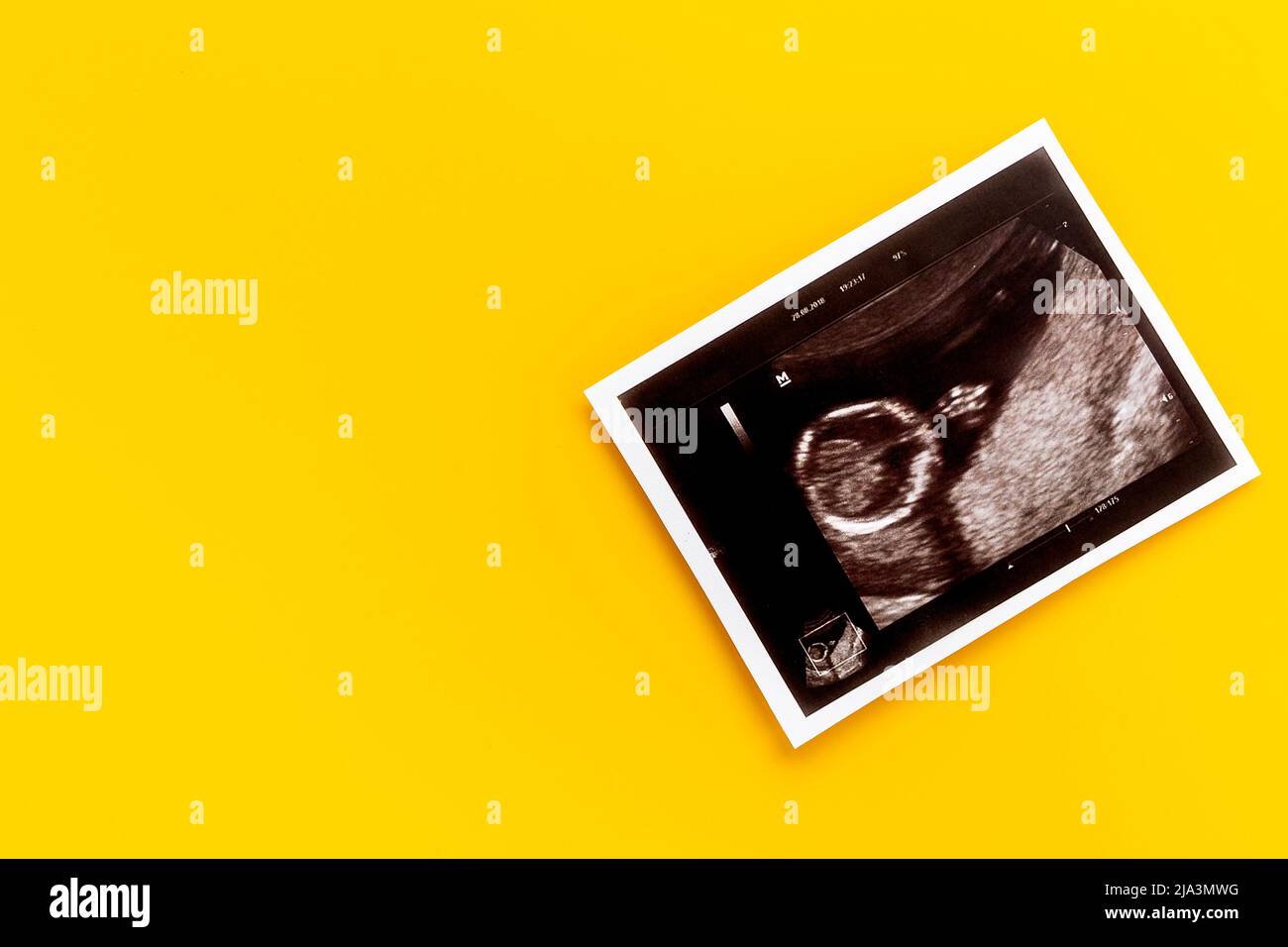 Prenatal ultrasound screening of unborn baby. Pregnancy background