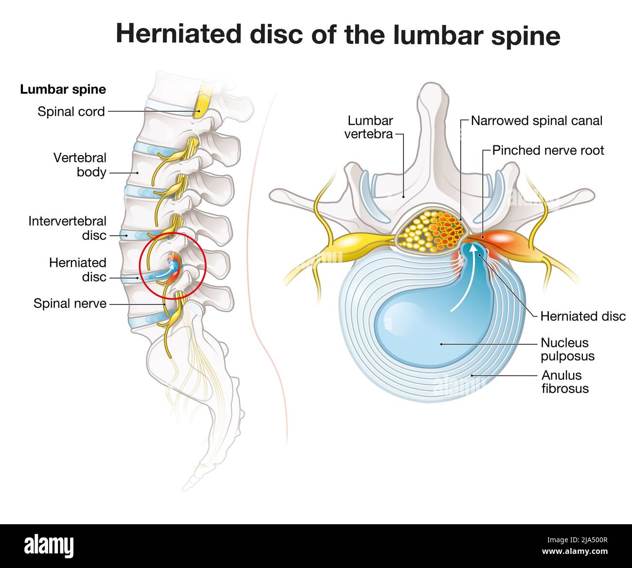 Illustration showing lumbar vertebra with intervertebral disc and