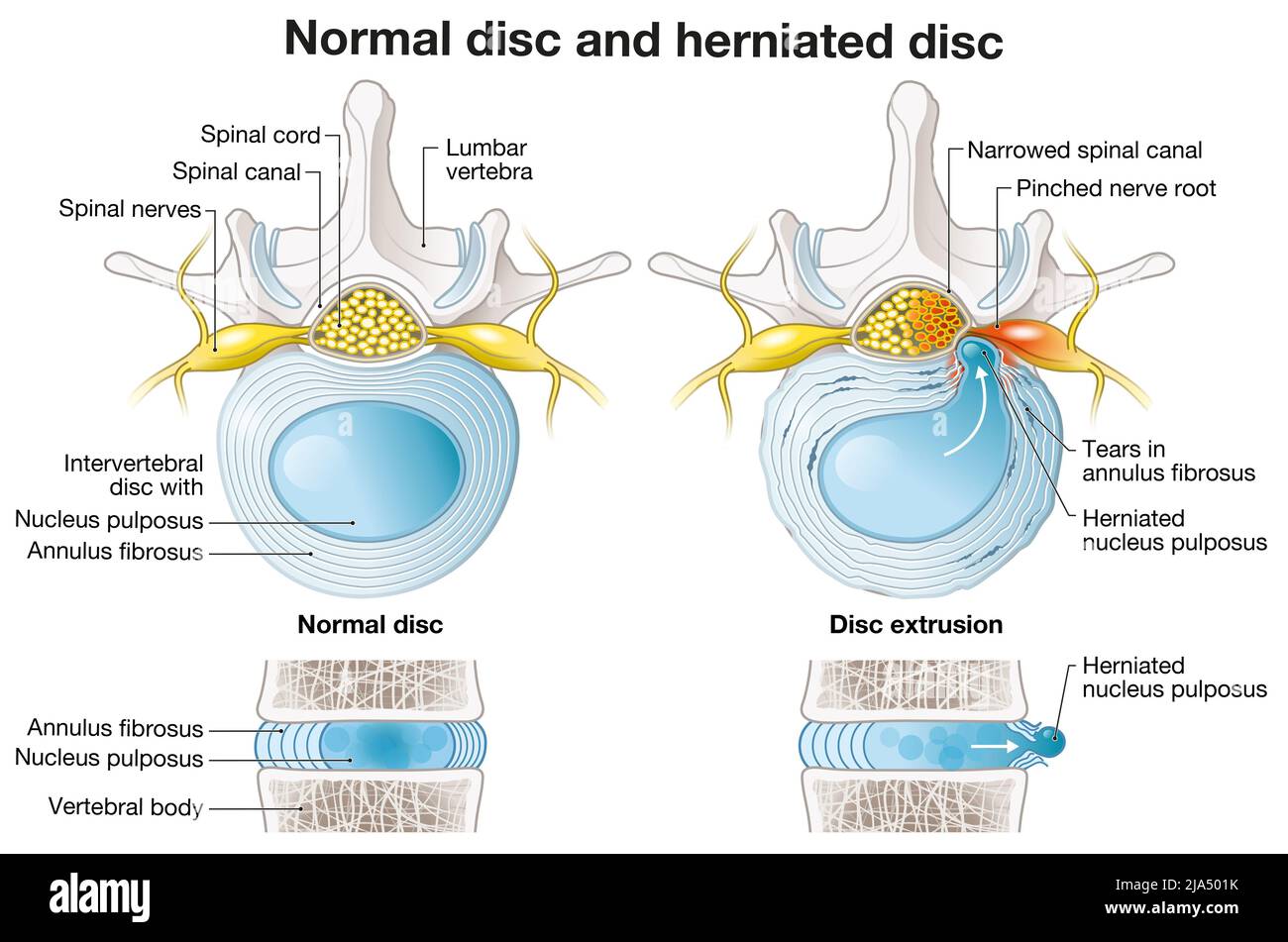 Illustration showing normal disc and herniated disc, slipped disc