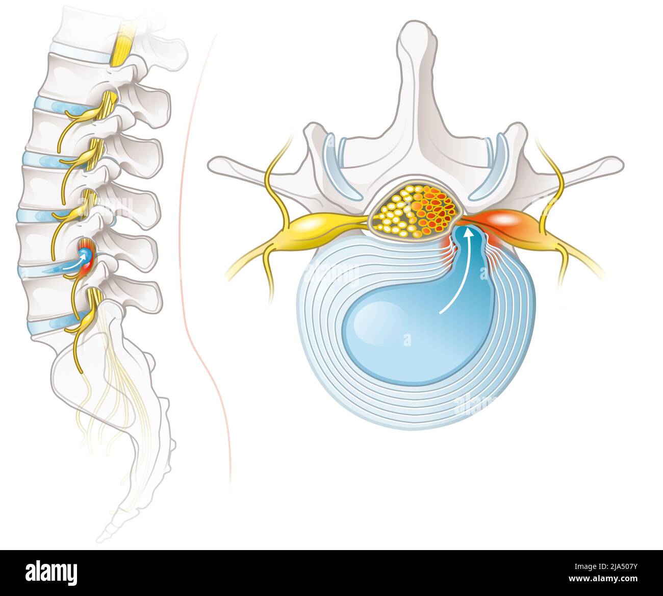 Illustration showing lumbar vertebra with intervertebral disc and