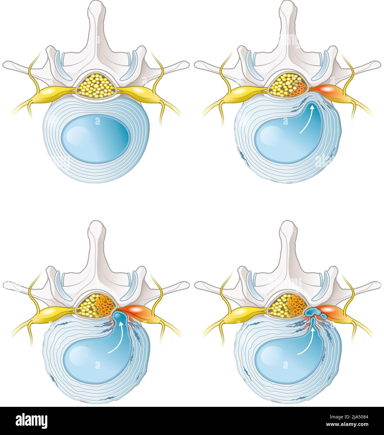 Lumbar disc extrusion icd 10 at terry prater blog