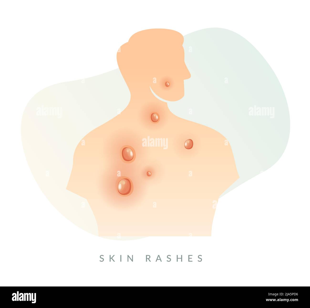Monkeypox - Skin Rashes and Spots as Symptoms - Icon as EPS 10 File ...