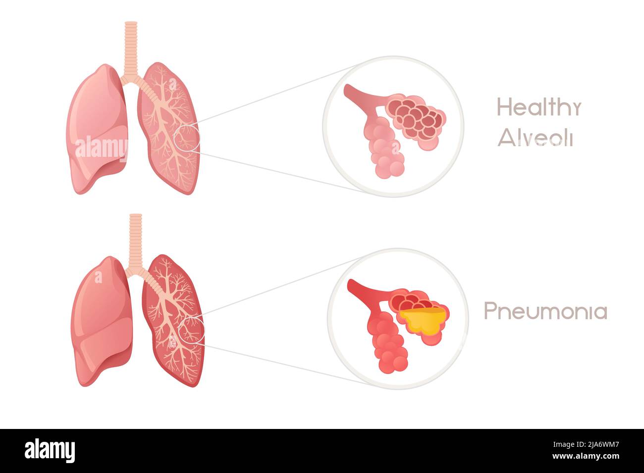 Human Lungs alveoli with pneumonia cartoon design human anatomy organ  vector illustration on white background Stock Vector Image & Art - Alamy