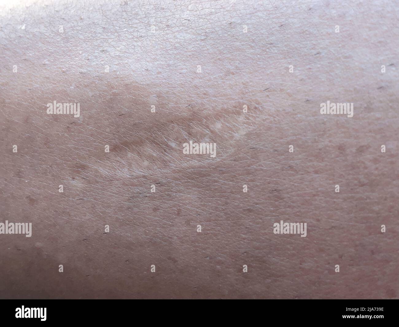 Closeup, healed scar on the skin of human body Stock Photo Alamy