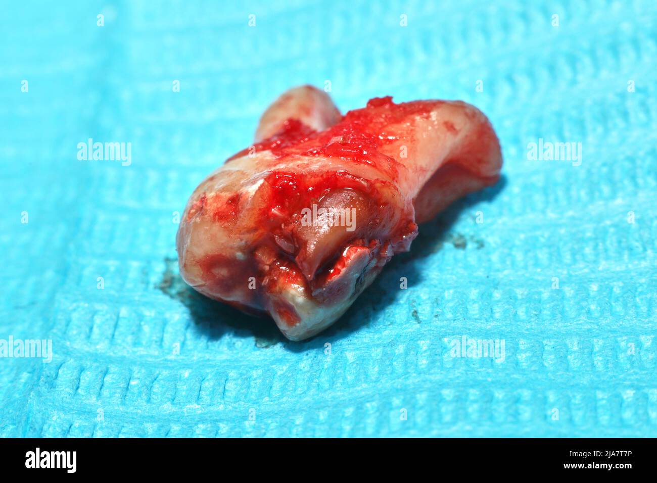 An extracted wisdom tooth on a sterile medical paper sheet Stock Photo