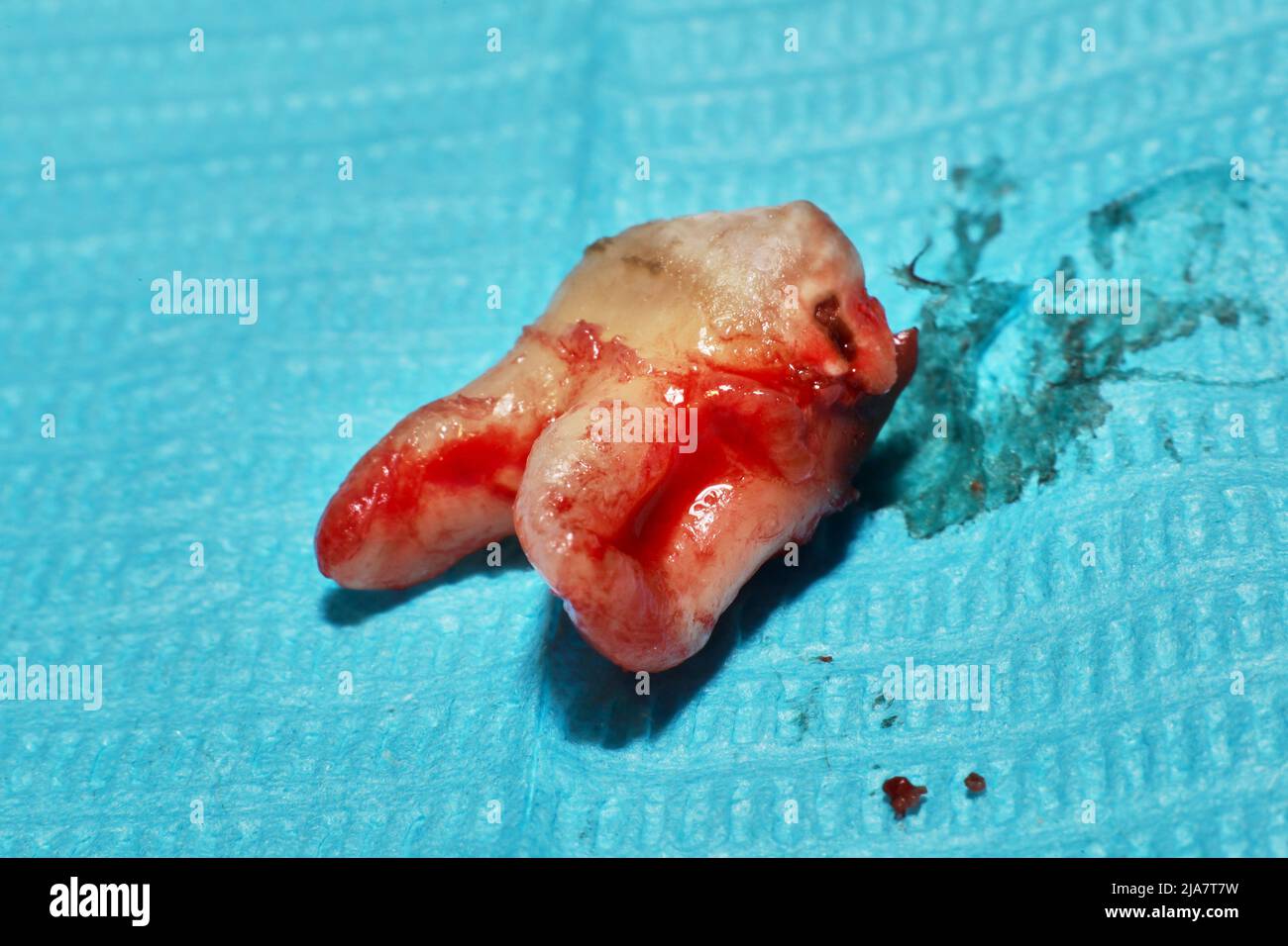 An extracted wisdom tooth on a sterile medical paper sheet Stock Photo