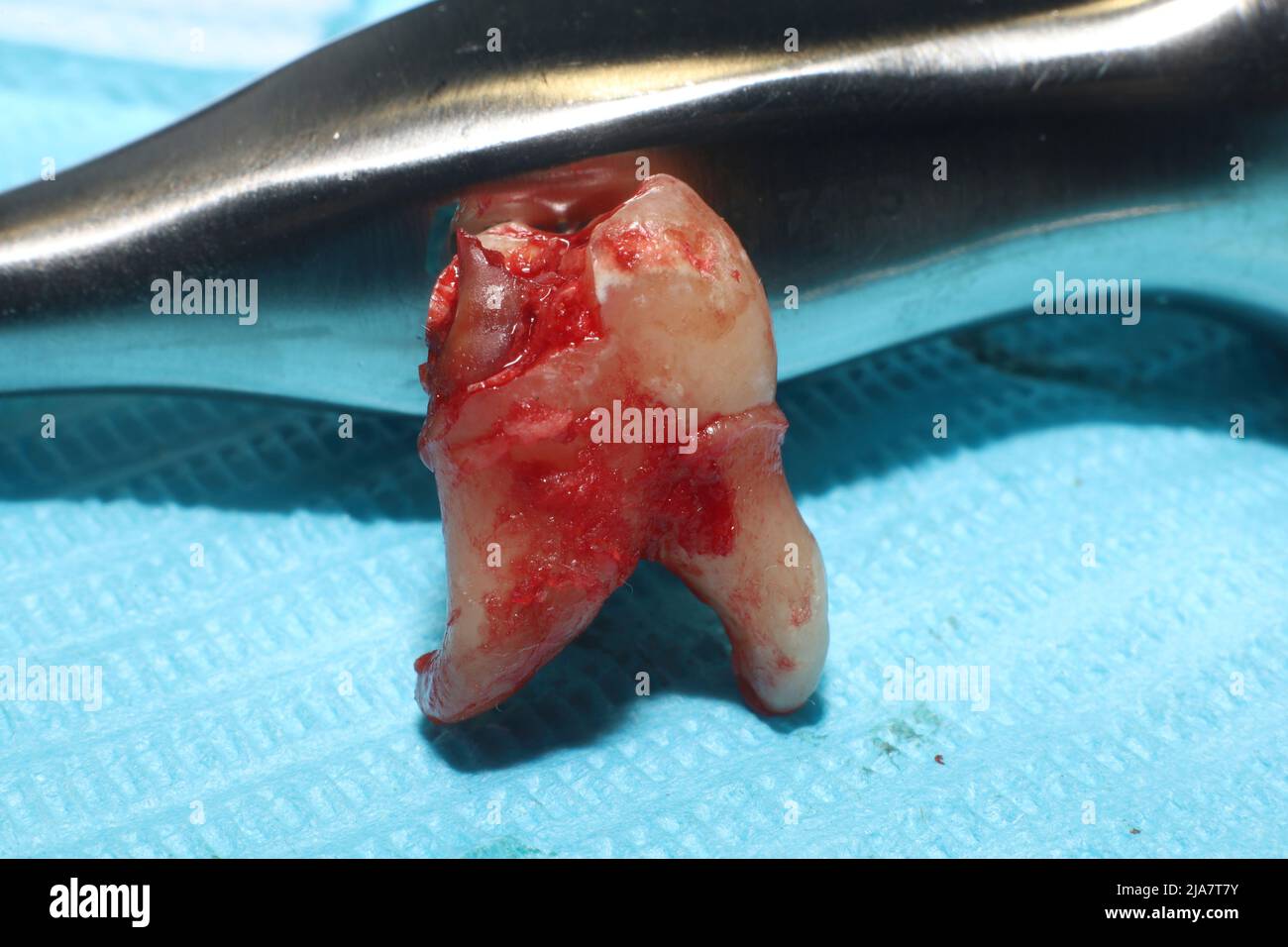 An extracted wisdom tooth on a sterile medical paper sheet Stock Photo
