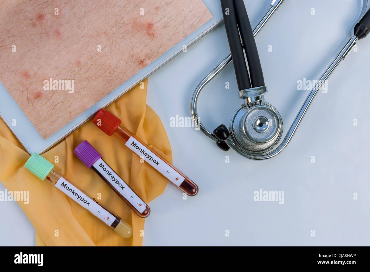 Skin rash and fever hires stock photography and images Alamy
