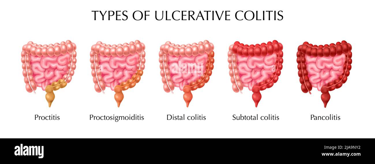 Ulcerative colitis types infographics including proctitis distal