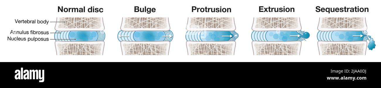 Illustration showing herniated disc schema. Normal disc. Bulge. Protrusion. Extrusion. Sequestration. Labeled illustration Stock Photo