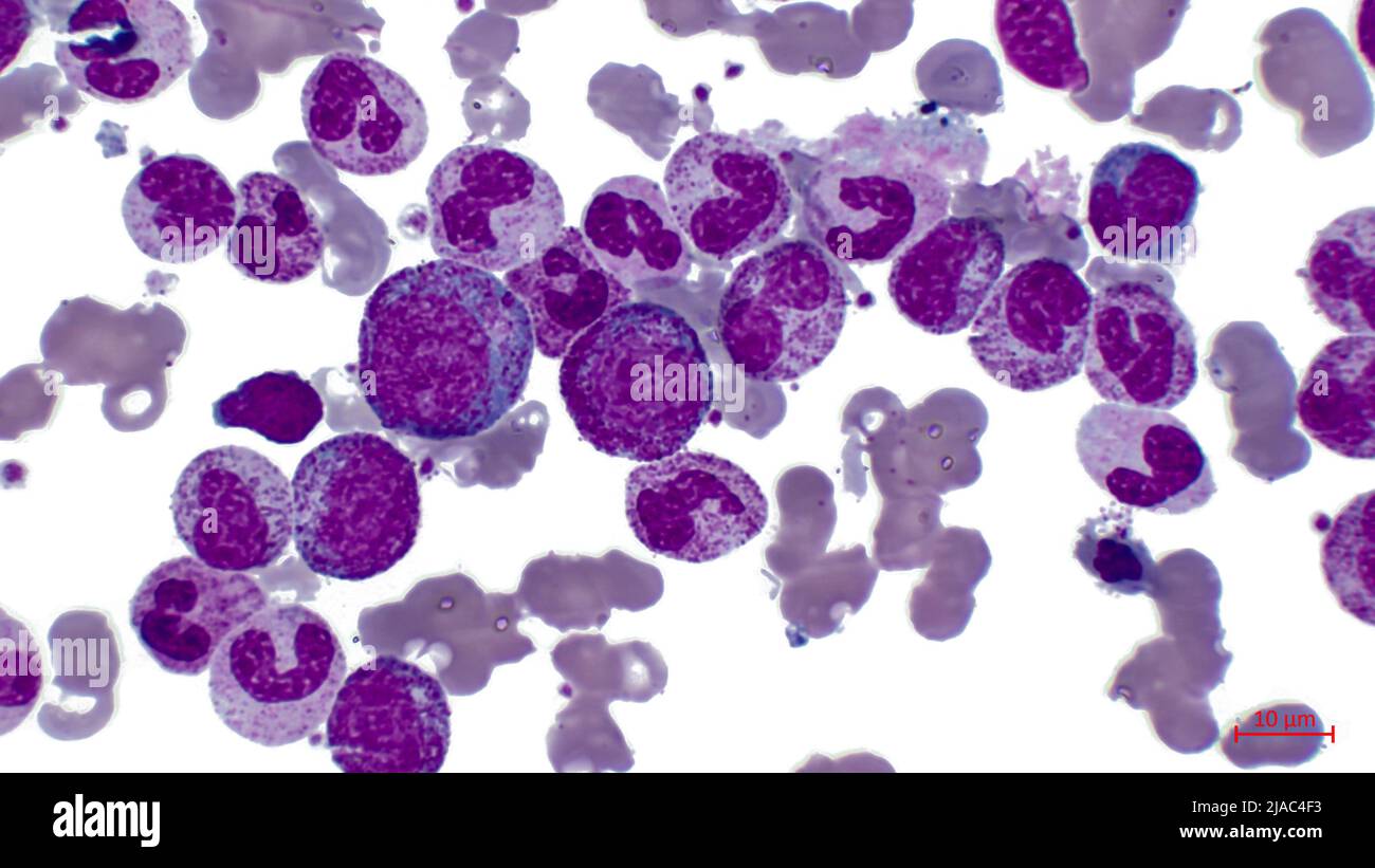 Photomicrographs of agranulocytosis: myeloblast, neutrophilic metamyelocyte, promyelocyte, neutrophilic myelocyte, neutrophilic metamyelocyte. Stock Photo