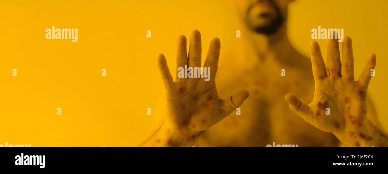 Male hands affected by blistering rash because of monkeypox or other viral infection on yellow background, wide banner. Stock Photo