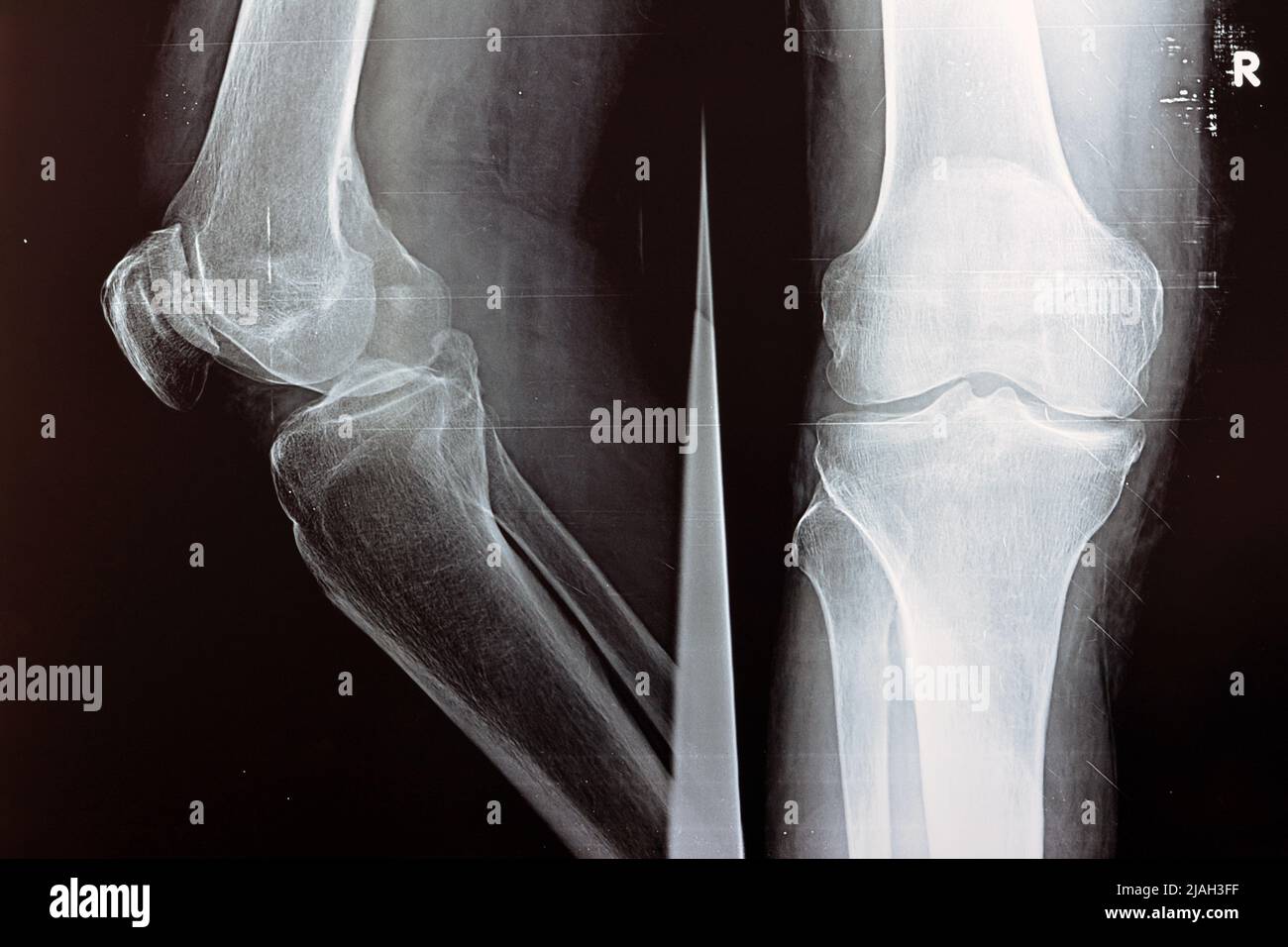 Plain X ray of the right knee shows apparent joint osteoarthritis ...