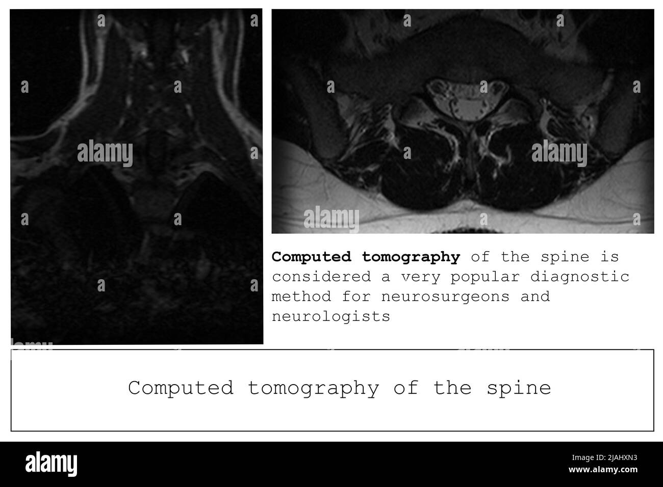 Computed tomography of the spine in a young man with a dorsal intervertebral hernia, diagnosis and detection of hernia and pain effects, banner layout Stock Photo