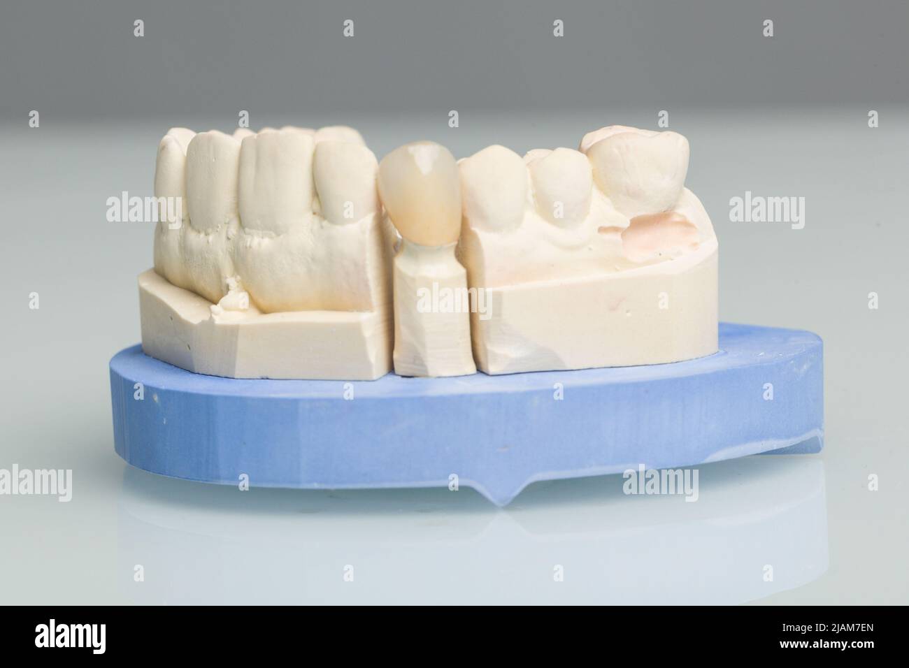 close up of tooth crown or implant in dental laboratory Stock Photo Alamy