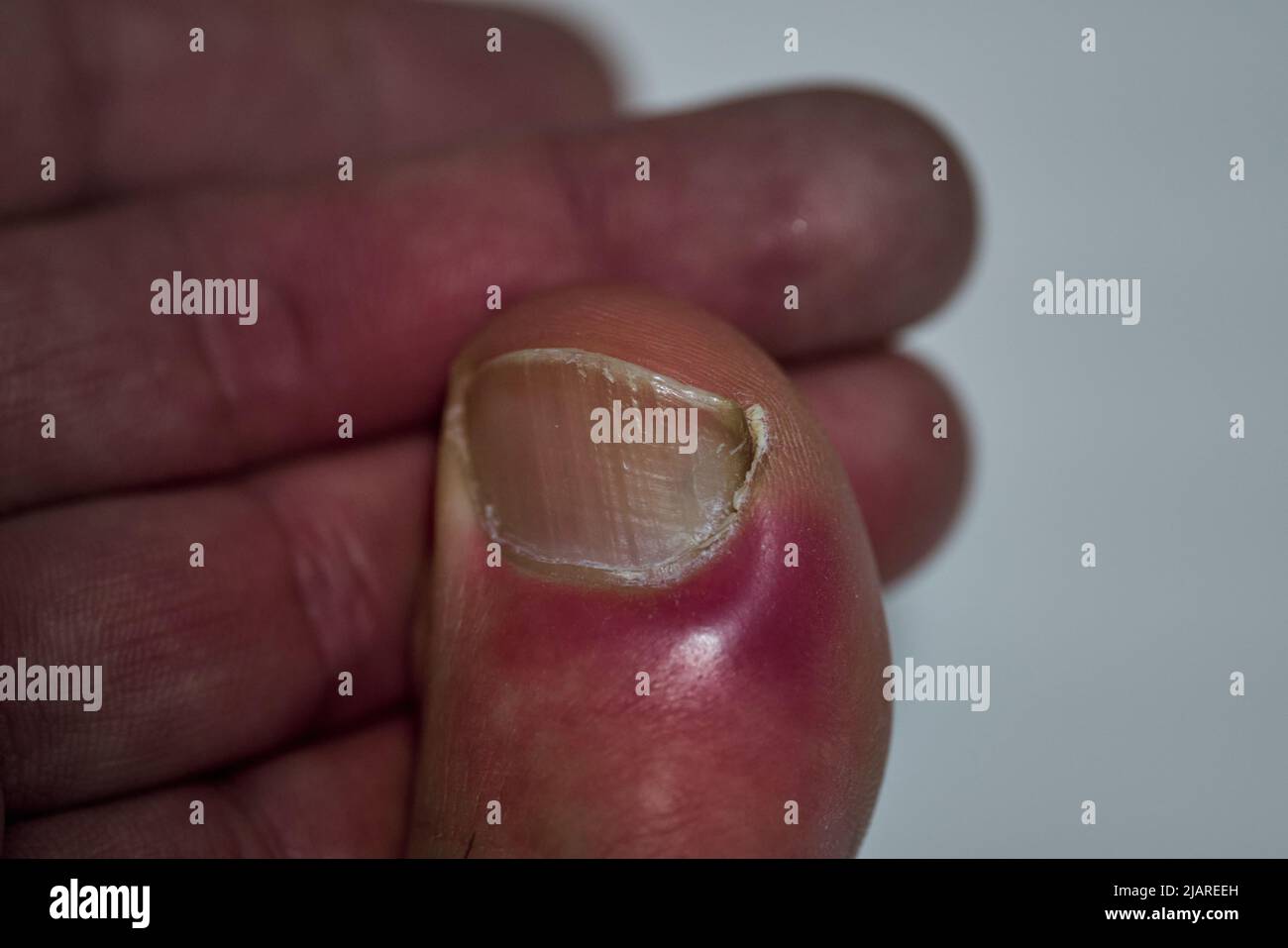 Nail infection hi-res stock photography and images - Page 2 - Alamy