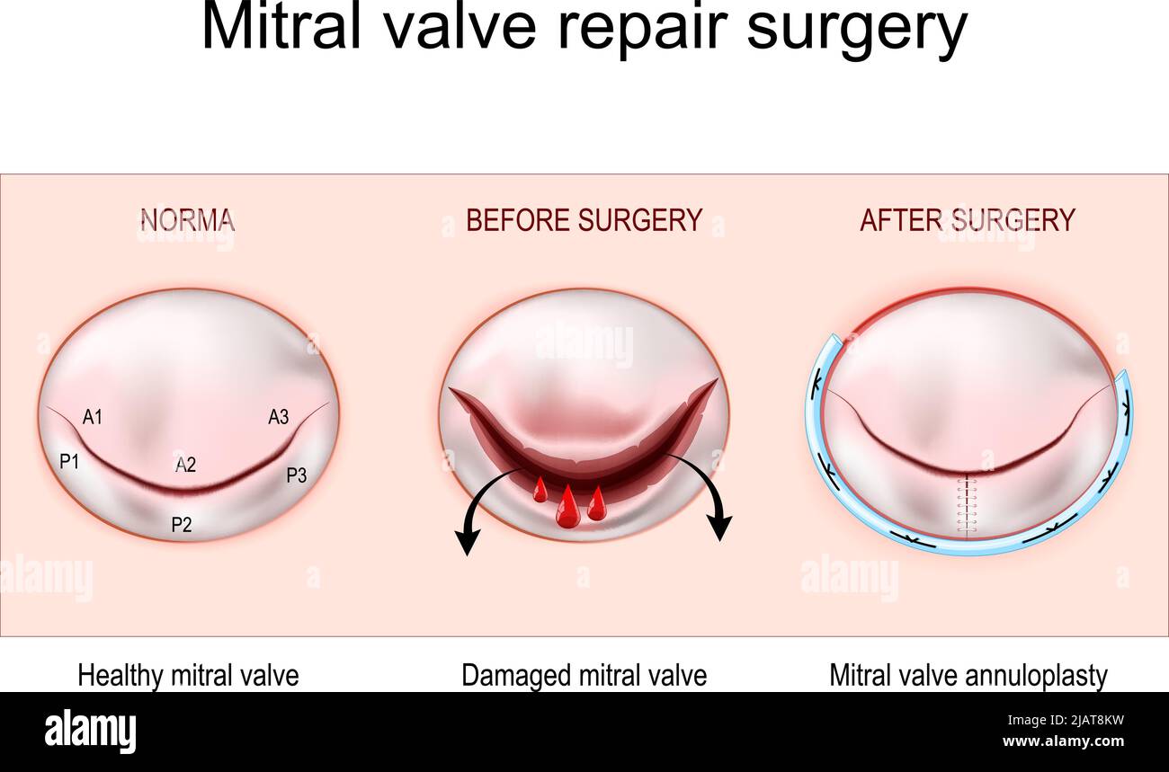 Mitral valve regurgitation - Diagnosis and treatment - Mayo Clinic