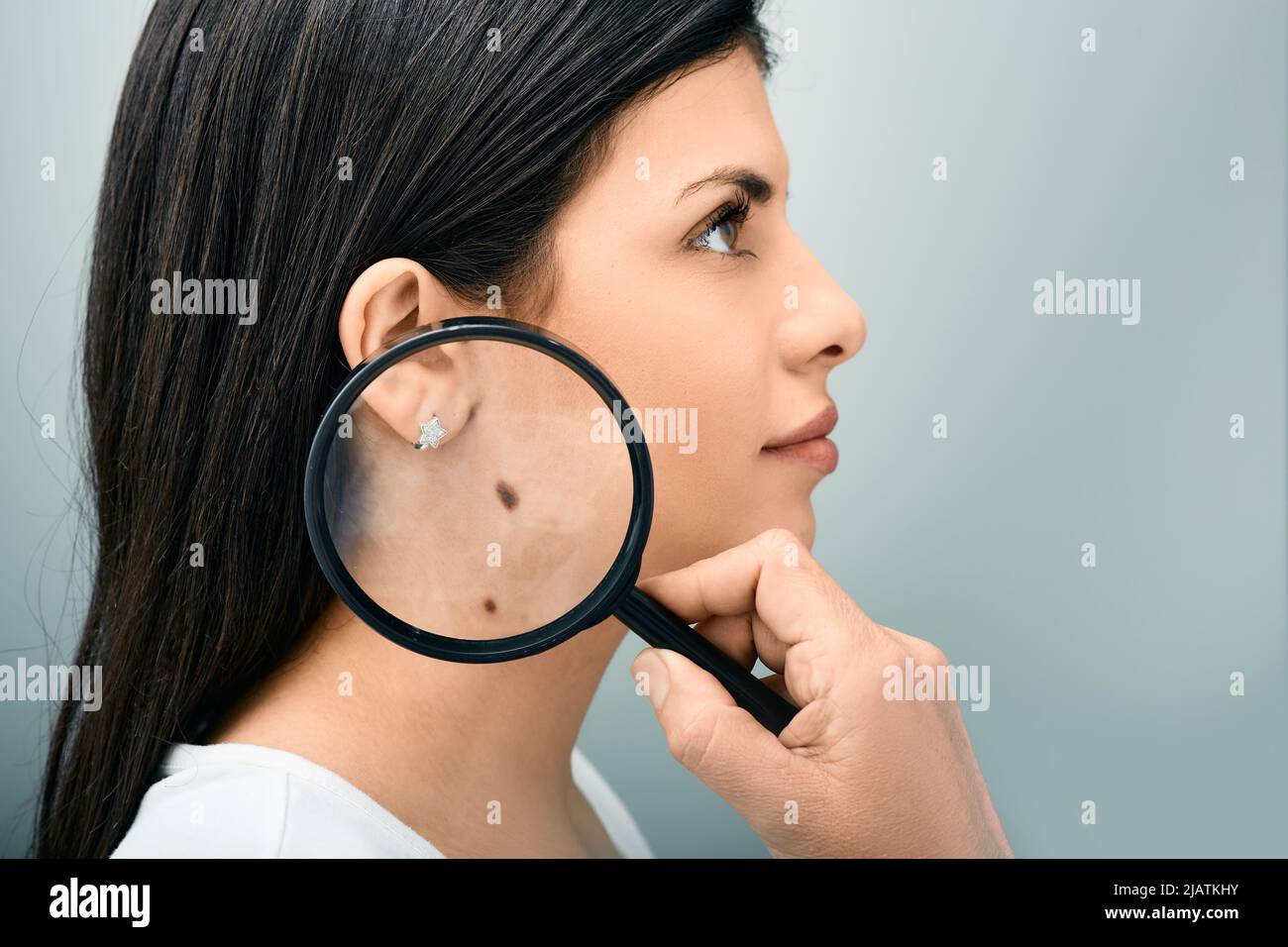 Woman with magnifying glass showing mole and birthmark on her body for prevention of melanoma and nevus exam. Mole dermoscopy Stock Photo