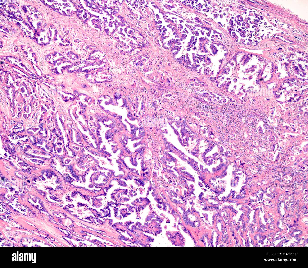 Ovarian mucinous cystadenocarcinoma, light micrograph Stock Photo - Alamy