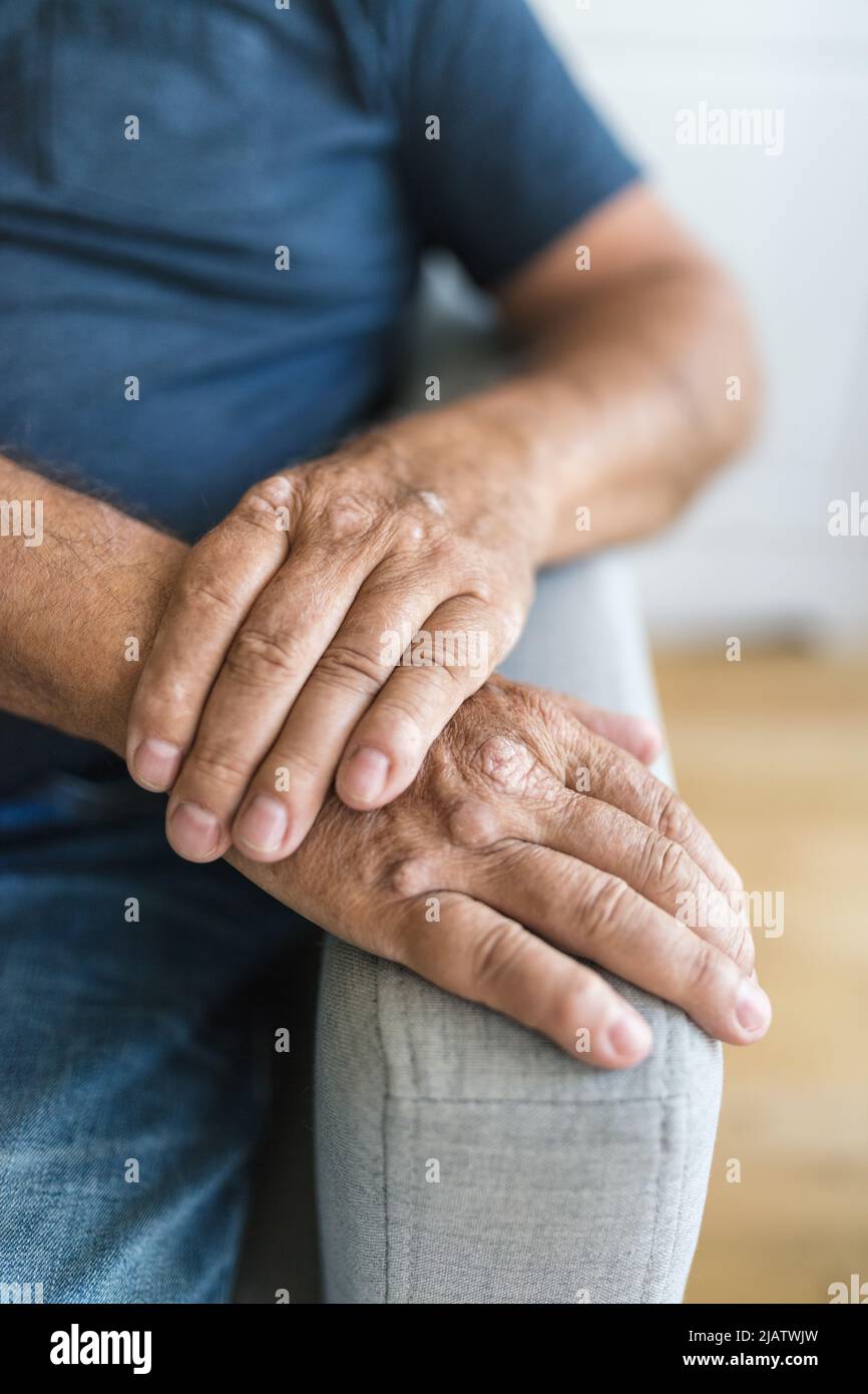 Elderly man suffering from psoriasis, closeup on hands Stock Photo