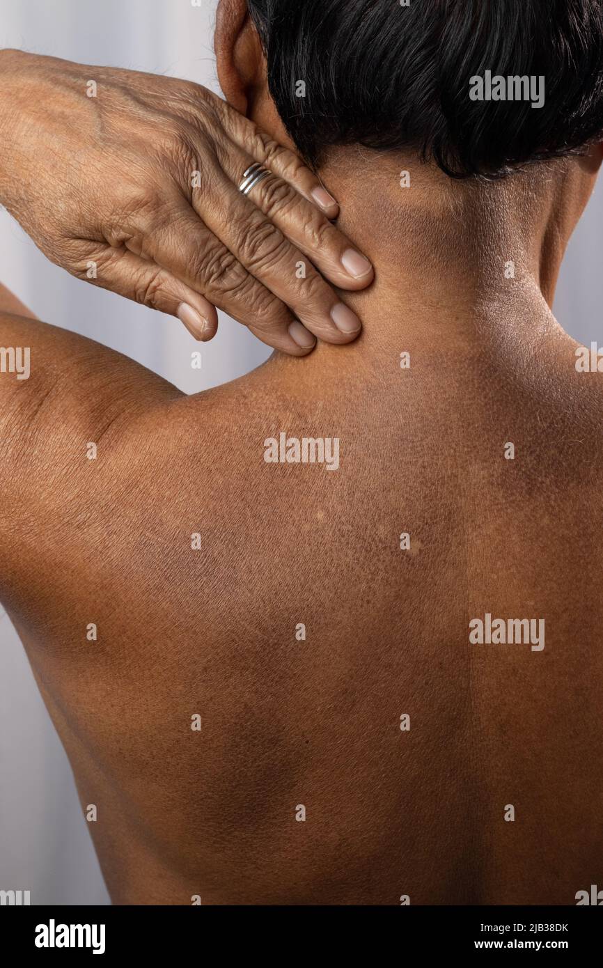 Close up of an Indian man showing white and black scars on his skin, healthcare concept Stock Photo