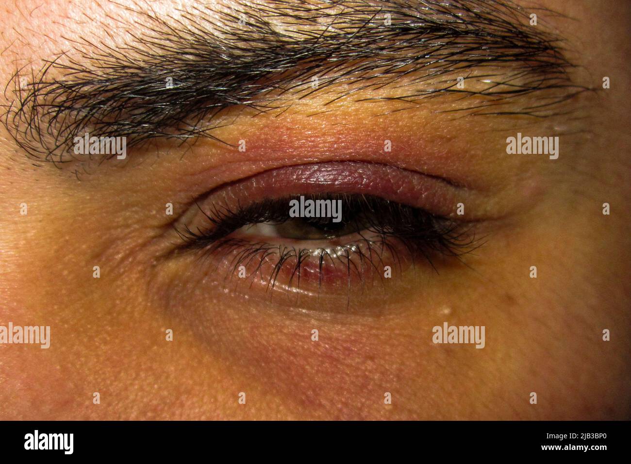A person having a eye infection. Rennes city. Illustrations of the city of Rennes. France. Stock Photo