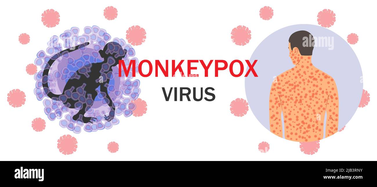 Banner with monkeypox virus cells, monkey silhouette, text and human body with rash on microbiology background. The concept of a viral disease and its Stock Vector