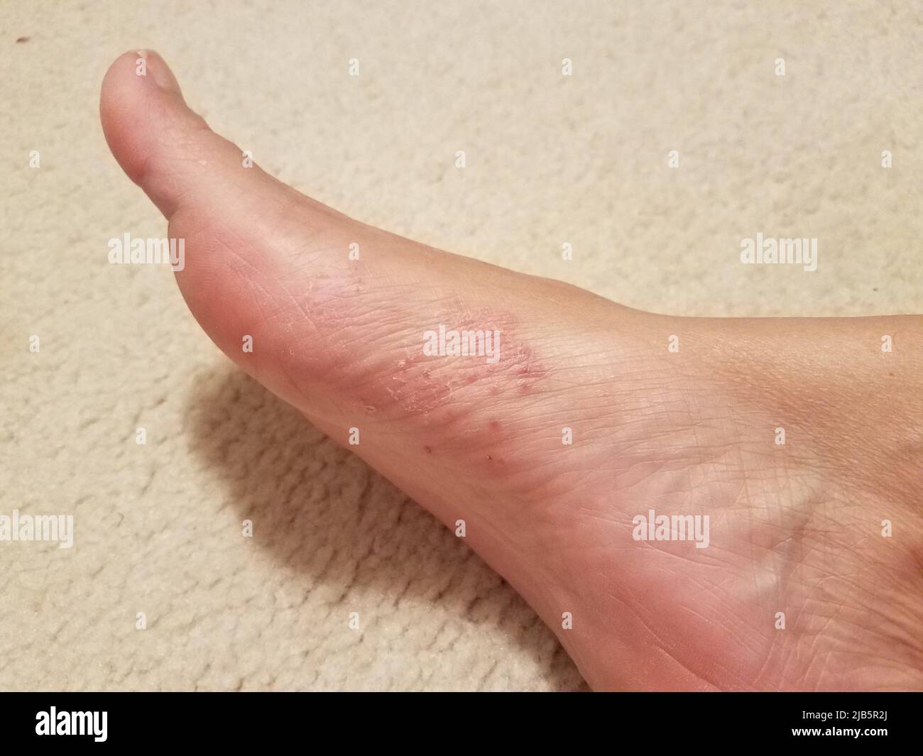 Foot fungus hires stock photography and images Alamy