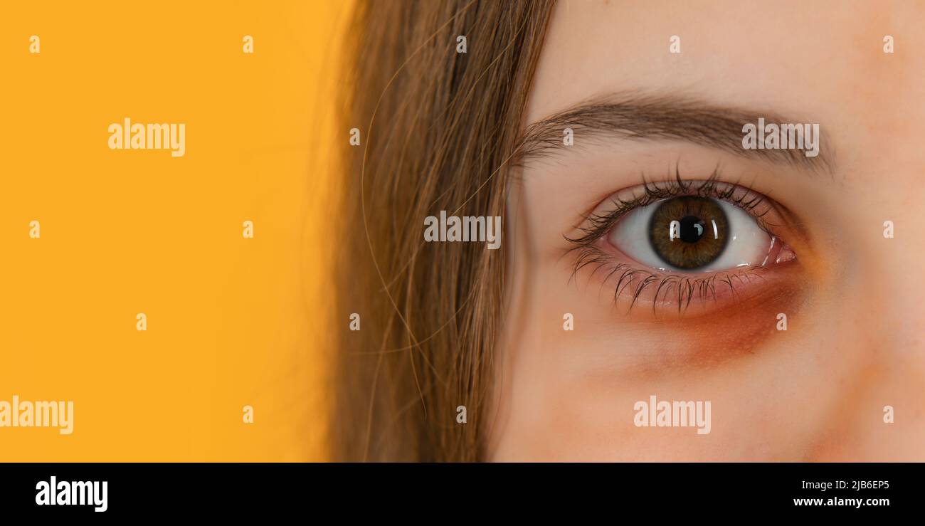 Close-up of bruised eye of teen child, wound hurt from accident. Close up of the face with a sadina. Kid with bruise. Stock Photo