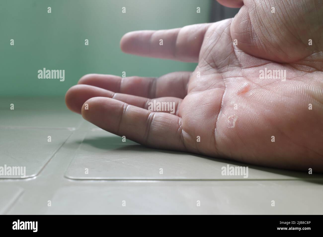 https://c8.alamy.com/comp/2JB8C8P/selective-focus-of-human-male-hand-with-blisters-caused-by-heavy-work-burn-and-friction-2JB8C8P.jpg