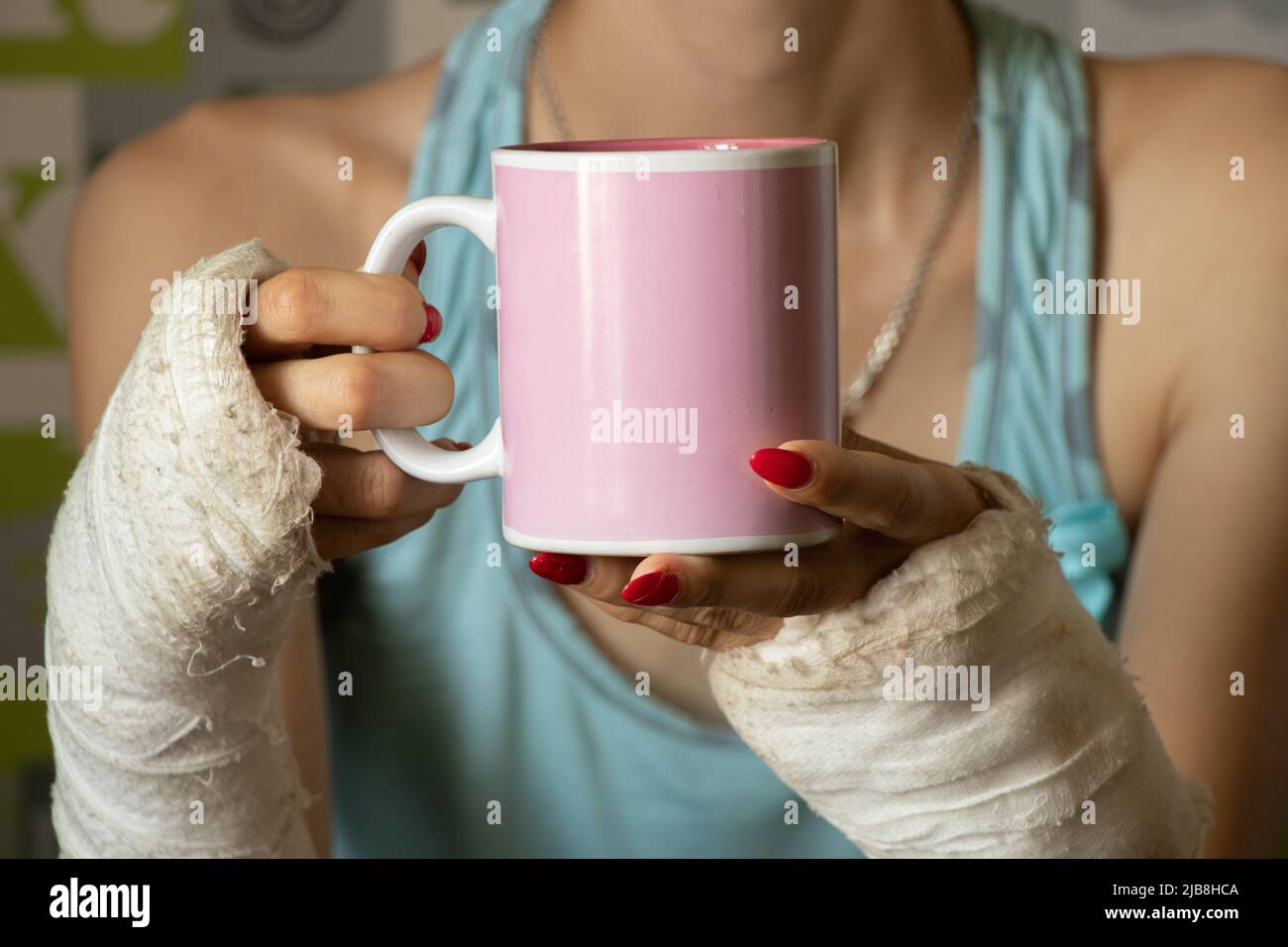 a girl with two broken arms in a cast holds a cup of tea in the kitchen for breakfast, broken arms in a cast, fractured limbs, injury Stock Photo