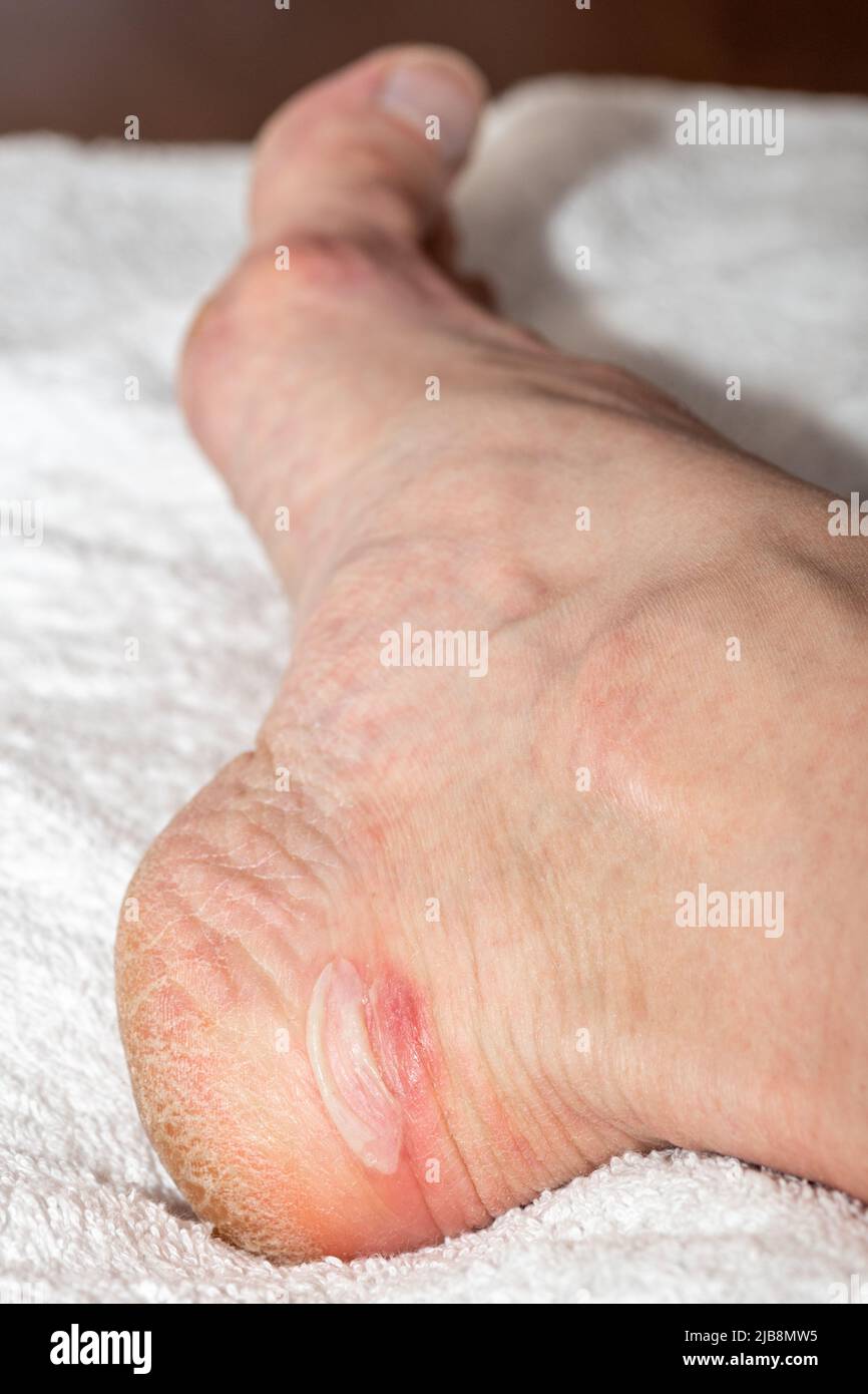 Callus removal hi-res stock photography and images - Alamy