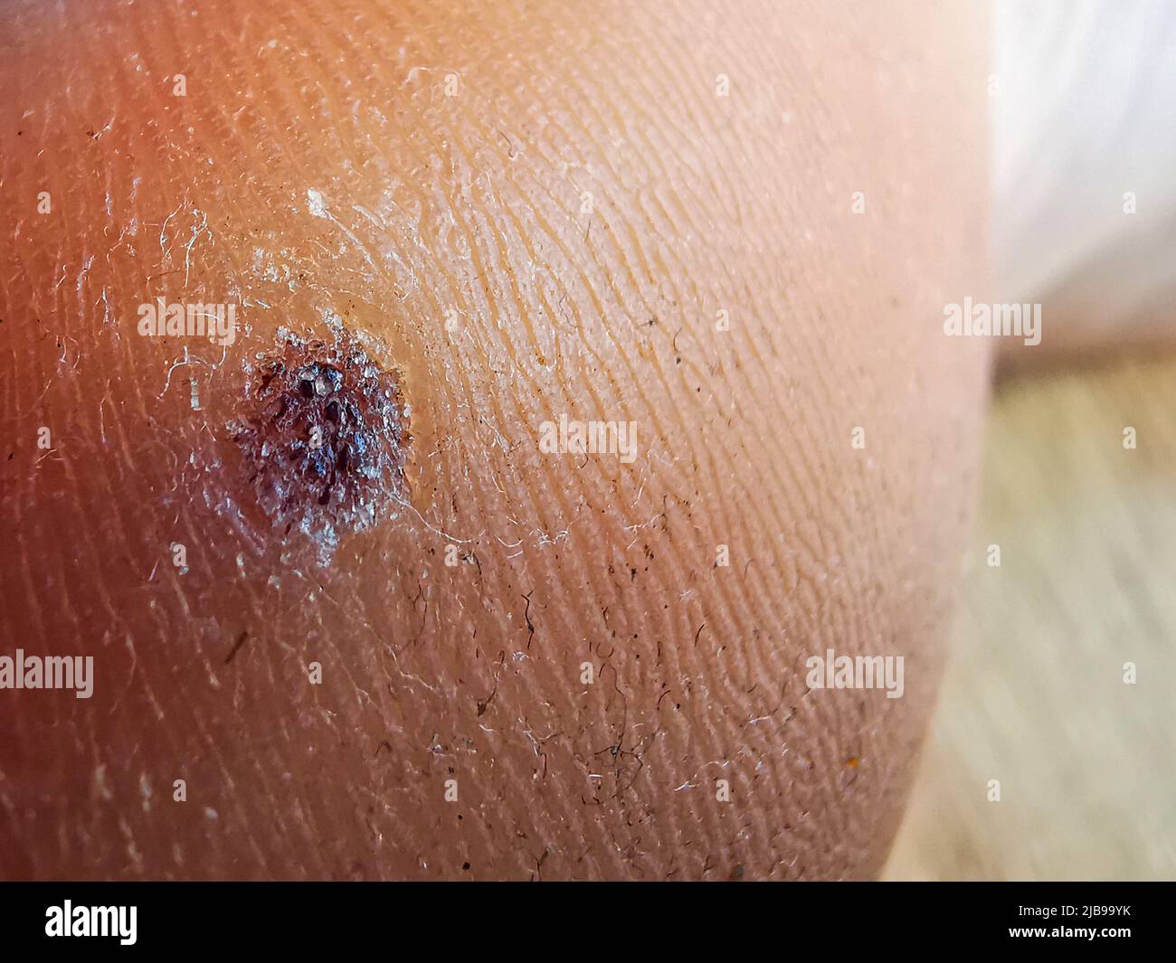Plantar black wart , skin problem close up, HPV Stock Photo Alamy