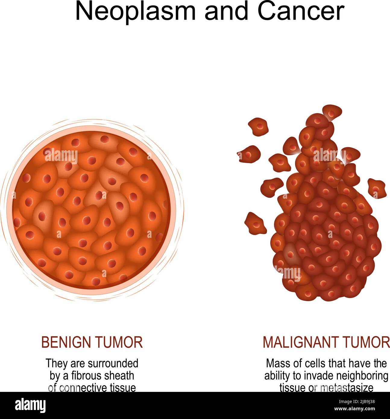 Neoplasm and Cancer. Comparison and difference of a malignant and benign tumor. benign tumor surrounded by a fibrous sheath of connective tissue Stock Vector