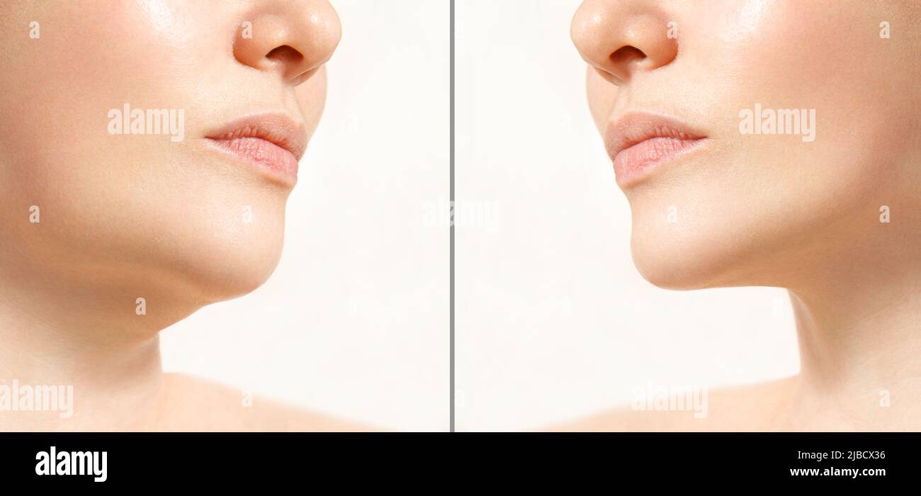 A close portrait of an aged woman before and after facial rejuvenation procedure. Correction of the chin shape liposuction of the neck. The result of Stock Photo