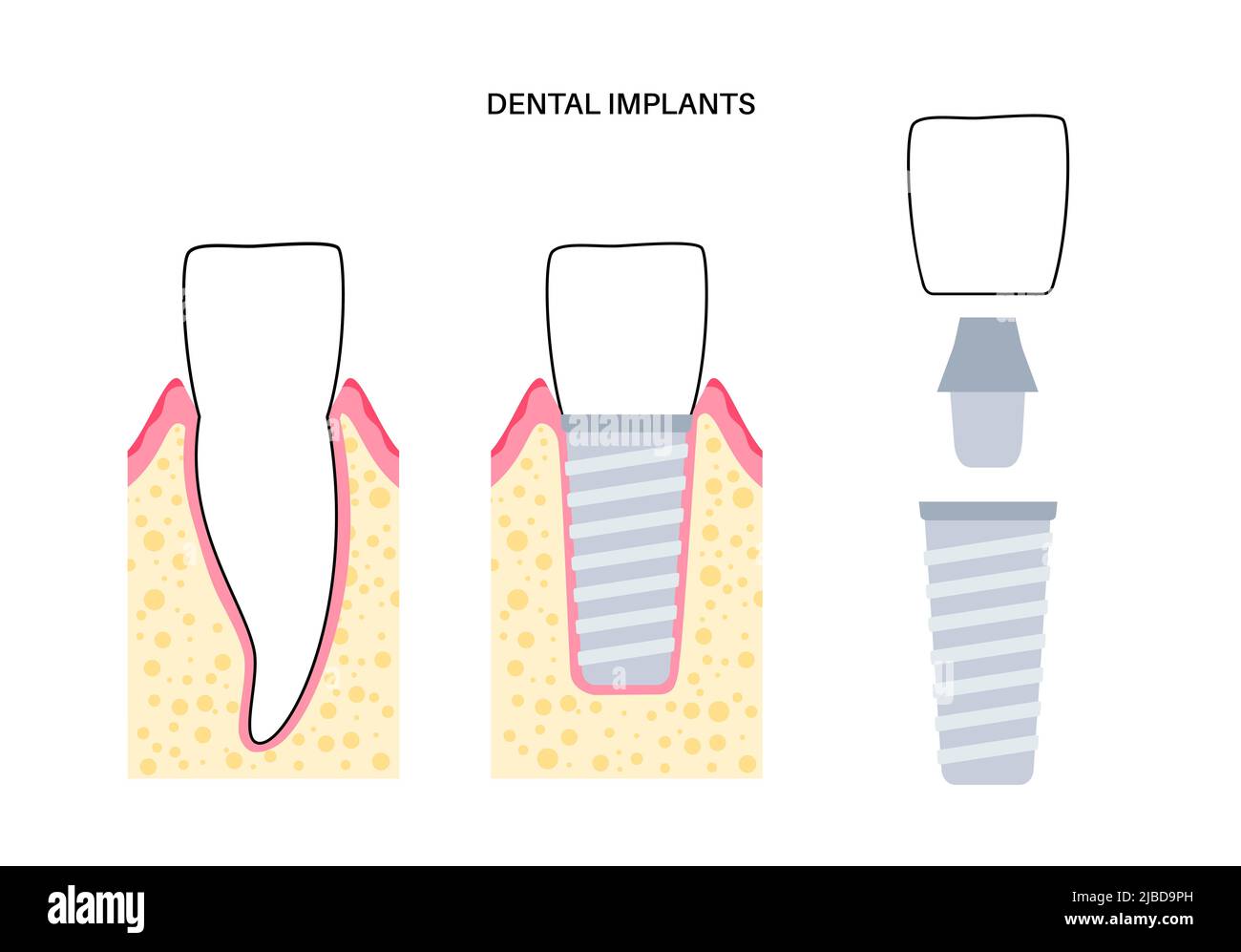 Dental implant, illustration Stock Photo