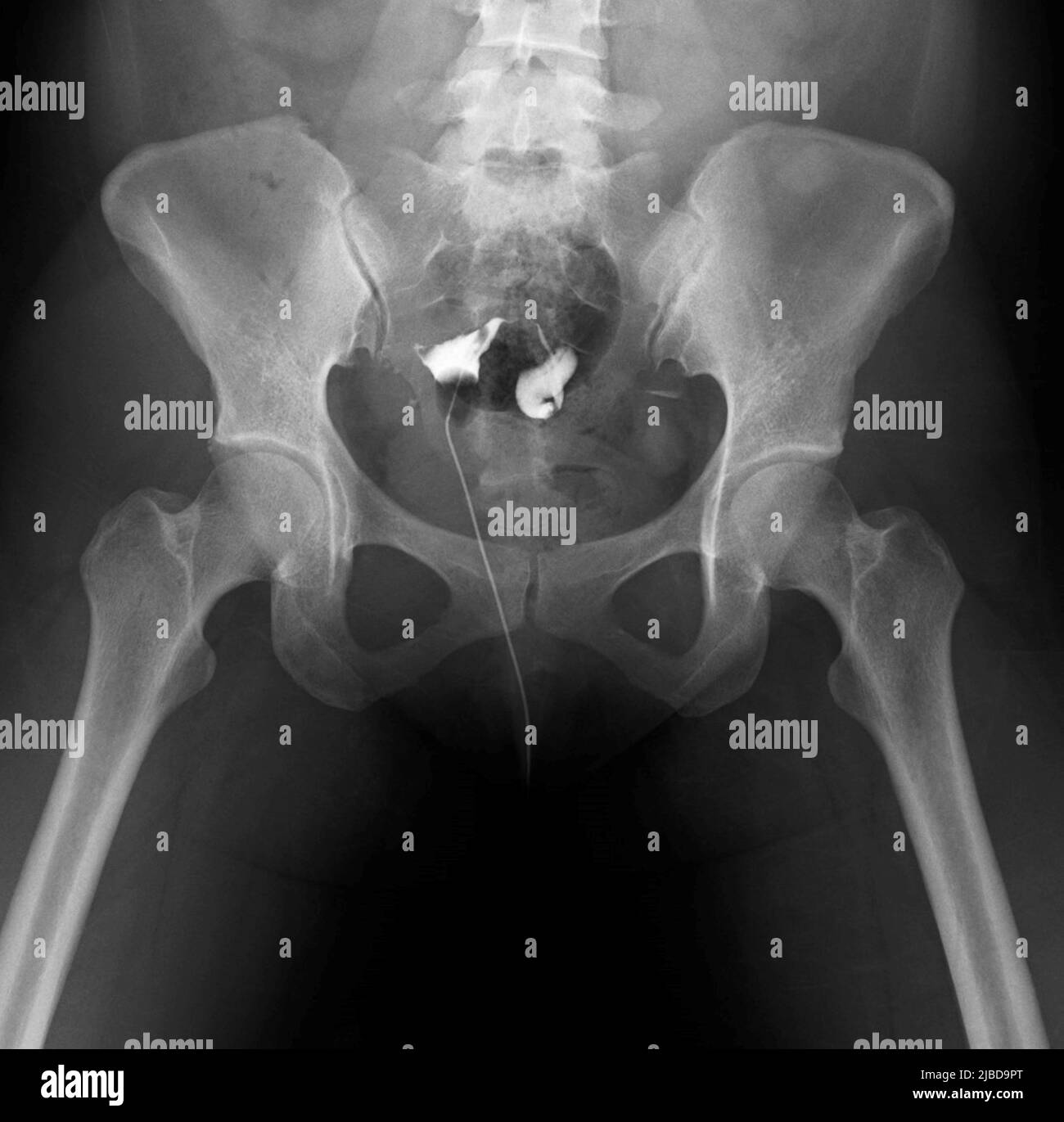 Obstructed fallopian tubes, X-ray Stock Photo - Alamy