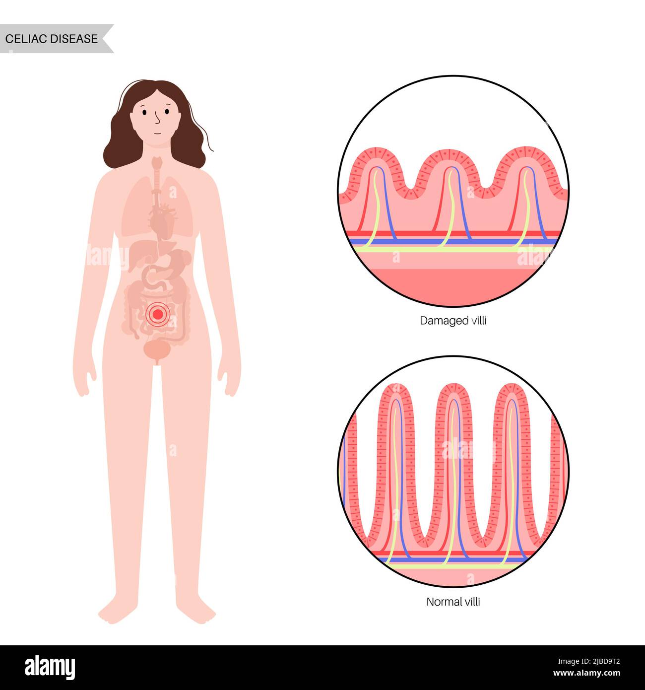 Celiac disease inflammation, illustration Stock Photo - Alamy