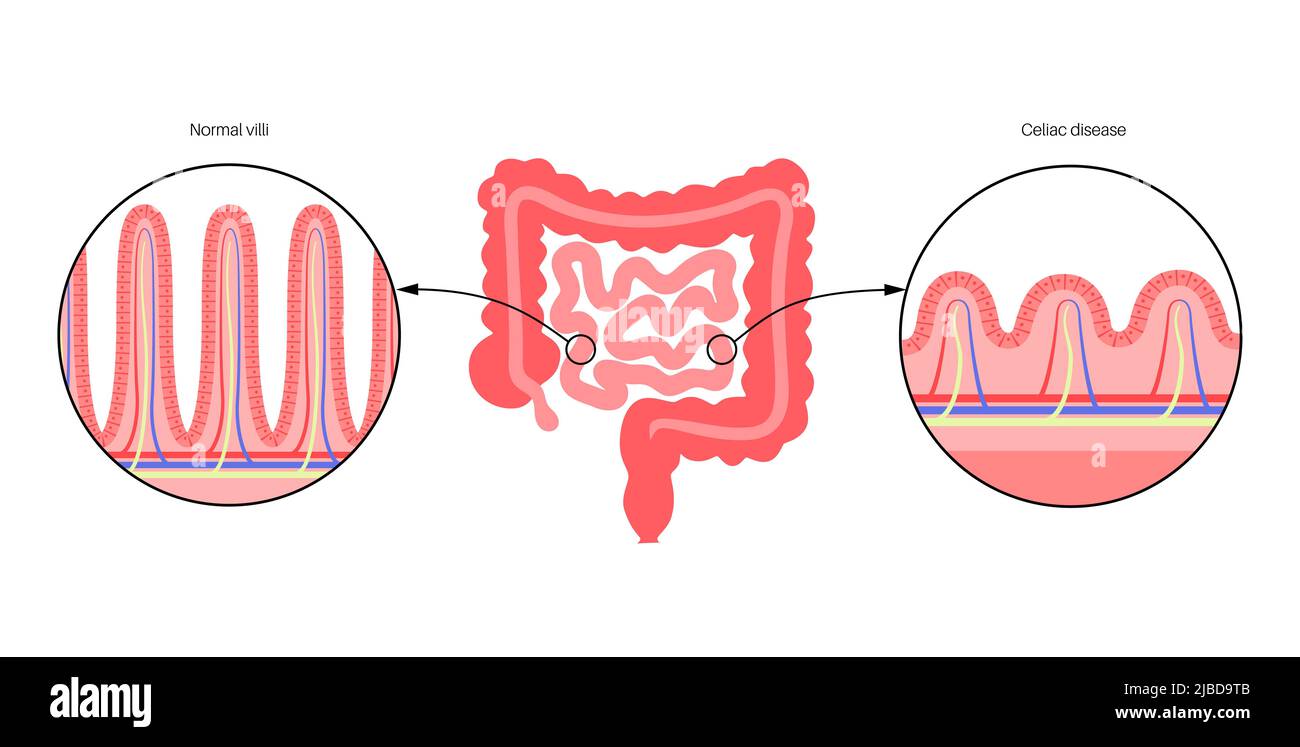 Celiac disease inflammation, illustration Stock Photo - Alamy