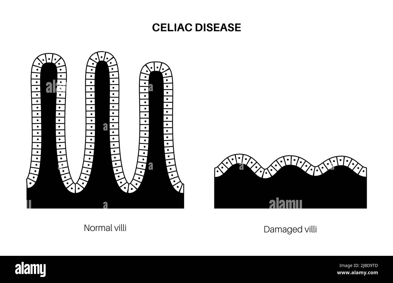 Celiac disease inflammation, illustration Stock Photo