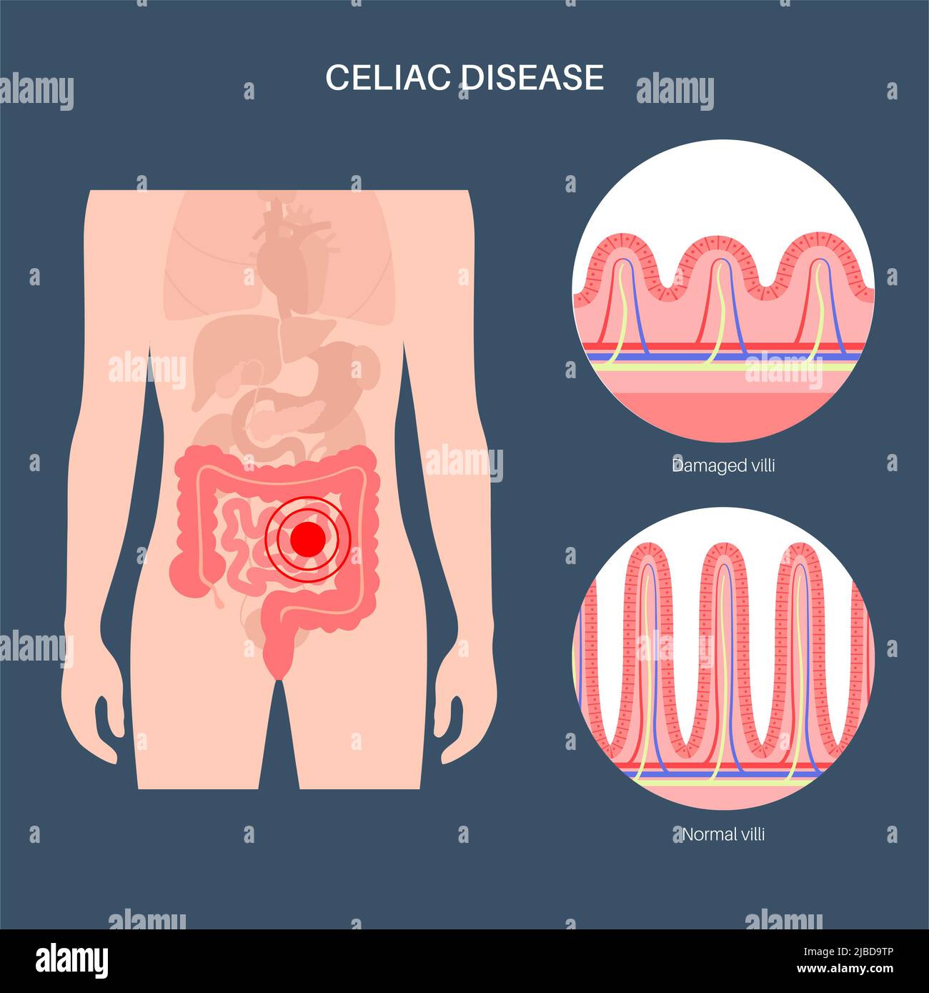 Celiac disease inflammation, illustration Stock Photo Alamy